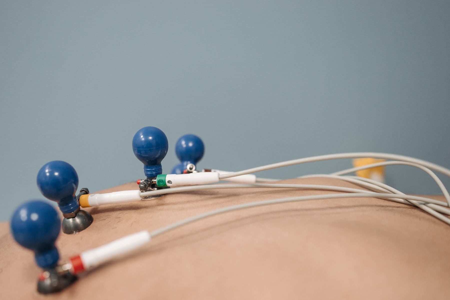 ECG electrodes with blue suction cups placed on a patient's chest.